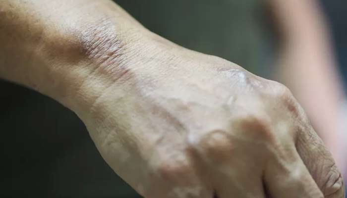 A hand of a person with leprosy. — Penpak Ngamsathain/File