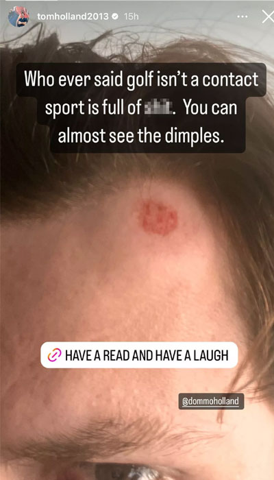 Tom Holland shares hilarious story of his head injury from a family golf game