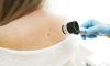 Melanoma skin cancer to reach record high rates