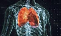 Lung Cancer Slowed In 60% Patients In New Drug Trial