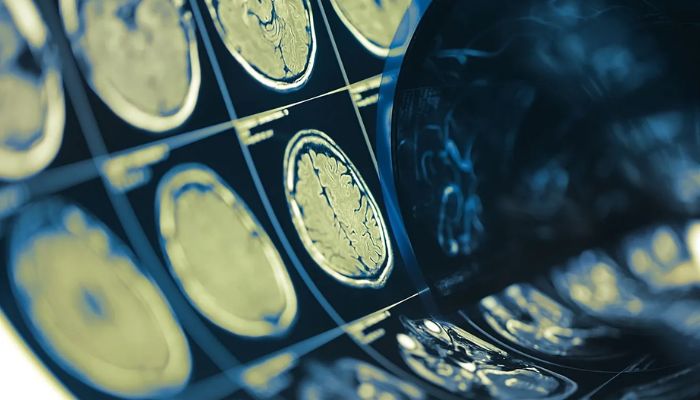 The end of privacy? brain implants aim to decode humans inner thoughts