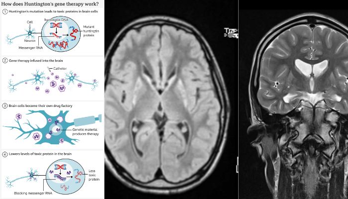 Huntingtons disease sees first-ever successful treatment in medical breakthrough