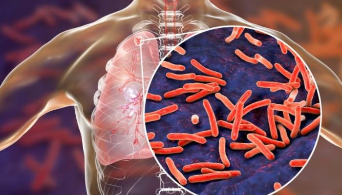 Medical warning: deadly Victorian disease has similar symptoms to covid new variant