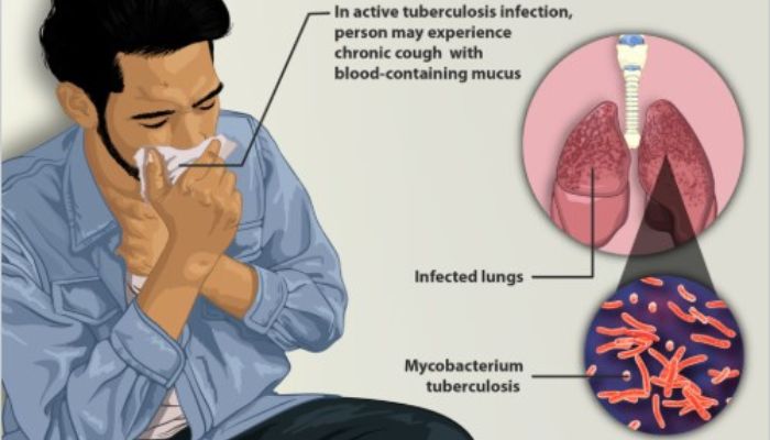 Deadly Victorian disease is back with symptoms similar to ‘Covid’ new variants