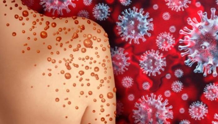 Health officials warns as Mpox is potentially on the rise in California