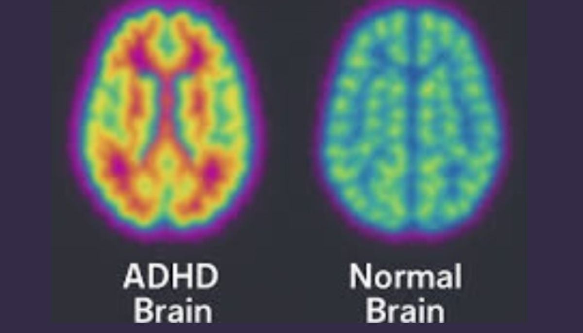 Attention deficit hyperactivity disorder ADHD affects millions of children, often lasting into adulthood, and their stimuli work differently than we actually assume, research shows
