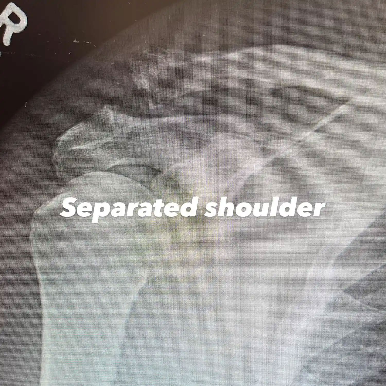 Channing Tatum shares update following separated shoulder surgery