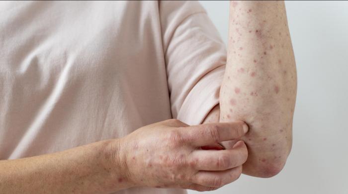 Expert discusses 'complications' of measles outbreak 