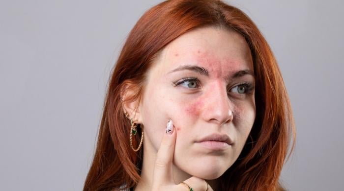 All you need to know guide to rosacea