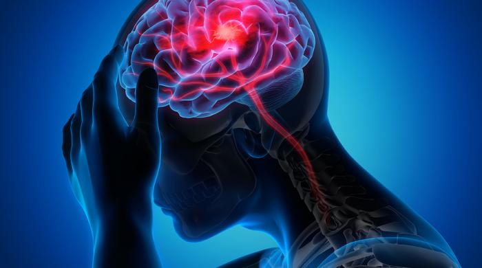 What you need to know about ischemic stroke