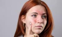All you need to know guide to rosacea