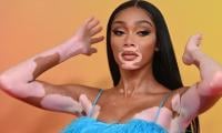 Winnie Harlow breaks vitiligo stereotypes: 'I'm not a sufferer' 