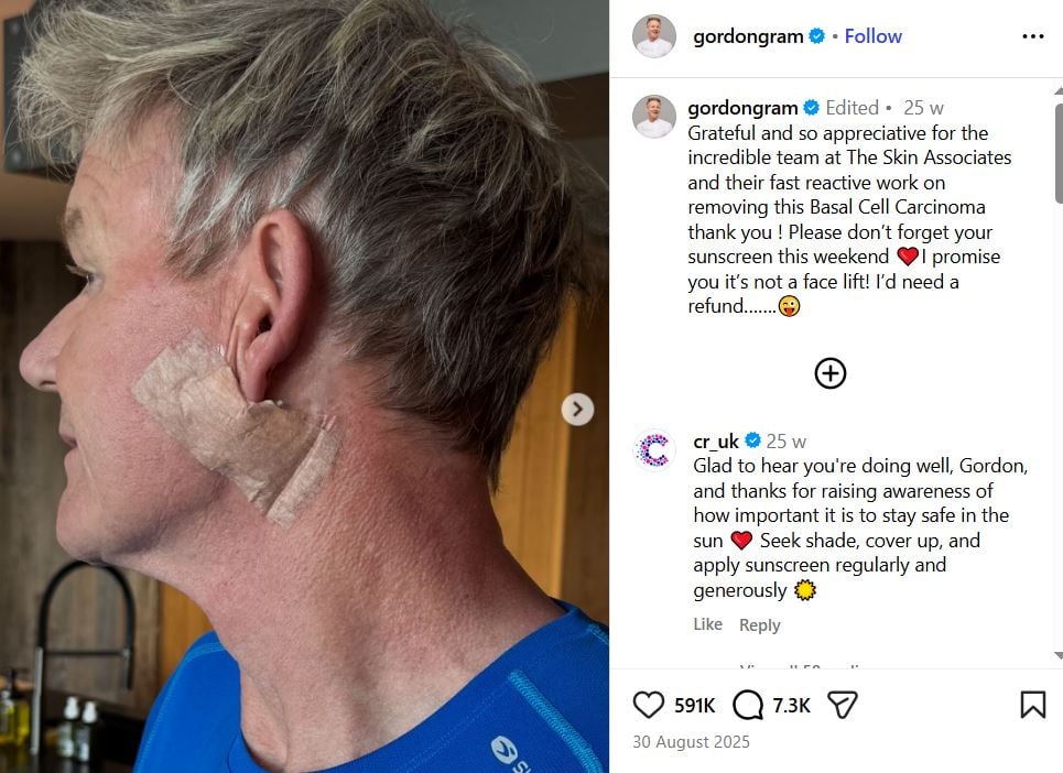 Gordon Ramsay on his basal cell carcinoma diagnosis