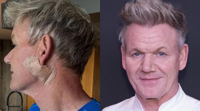 Gordon Ramsay on his basal cell carcinoma diagnosis