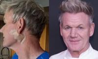 Gordon Ramsay on his basal cell carcinoma diagnosis