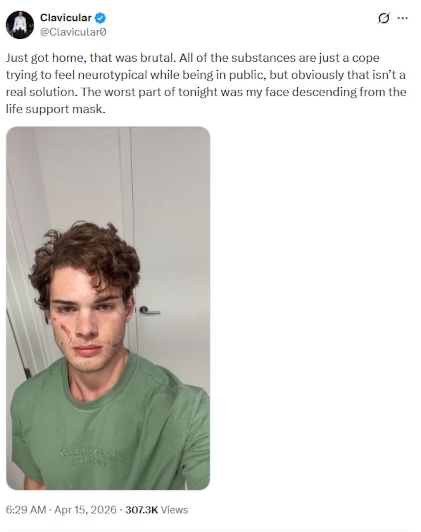 Clavicular overdose: Surgeon spots big red flags in young influencer before-and-after look