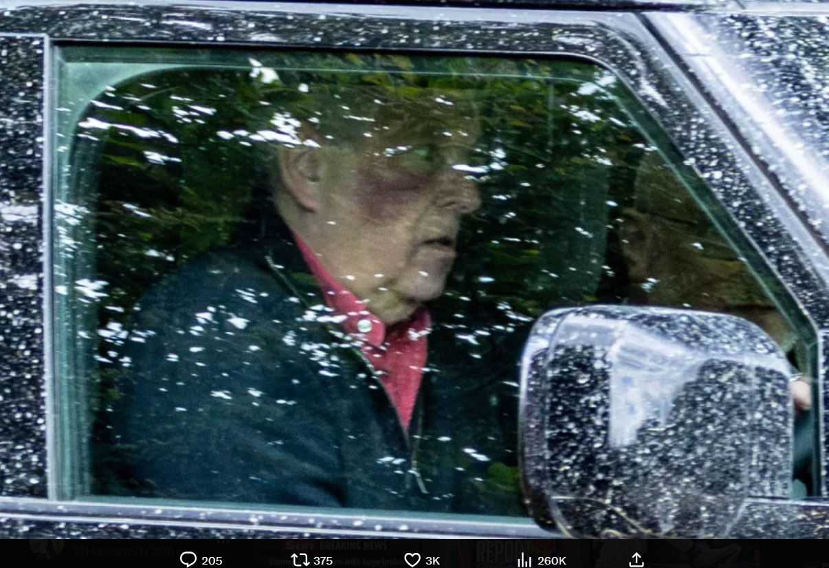 What is that mystery mark on Andrew Mountbatten-Windsors face?