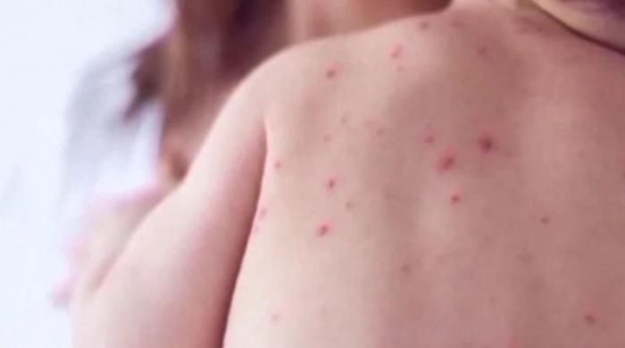 US measles cases surge past 2,000 as outbreak continues to spread