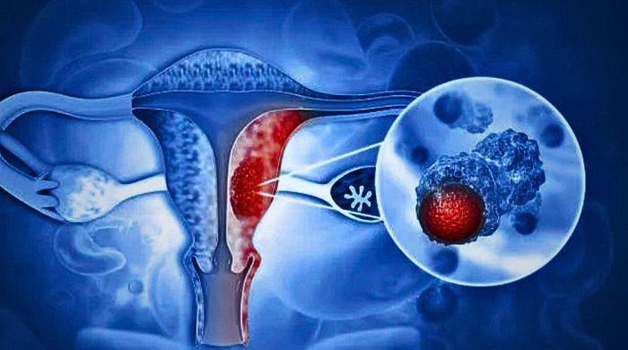 Study shows near-zero cervical cancer risk in young women