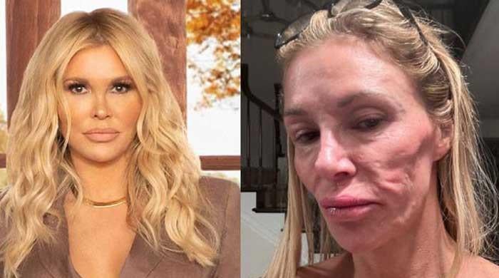 Brandi Glanville calls out doctors amid ongoing facial disfigurement struggle