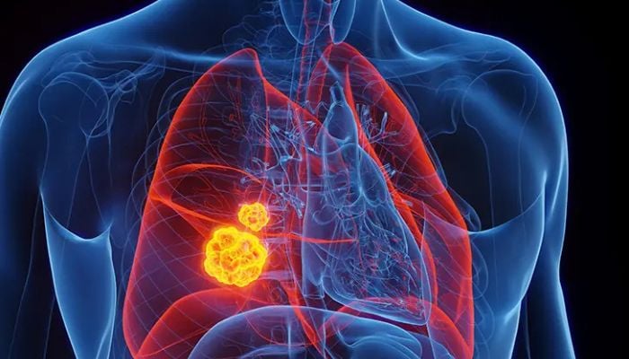 Study reveals Chinas lung cancer deaths to hit 760,000