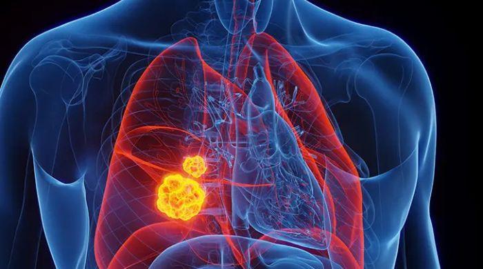 Study reveals China's lung cancer deaths to hit 760,000
