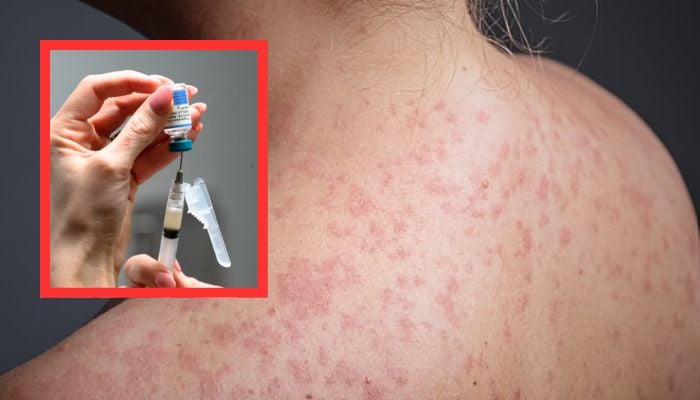 New York declares Measles state of emergency amid nationwide disease resurgence