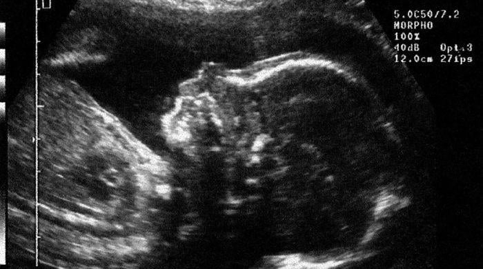 First-of-its-kind treatment shrinks unborn baby’s tumour before birth
