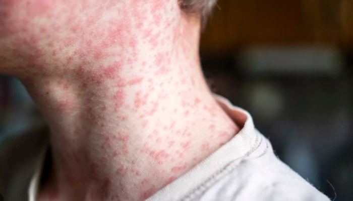 Measles cases in US top 4,000 nationwide, CDC reports