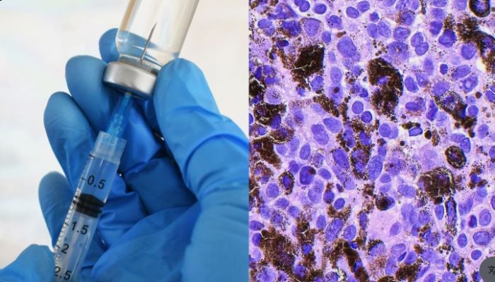 New personalized cancer vaccine cuts Melanoma recurrence risk by 42%, trial shows