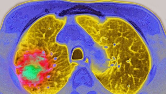 New Amgen drug combination shows survival gains in lung cancer trial