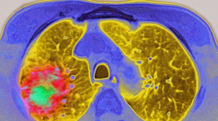 New Amgen drug combination shows survival gains in lung cancer trial